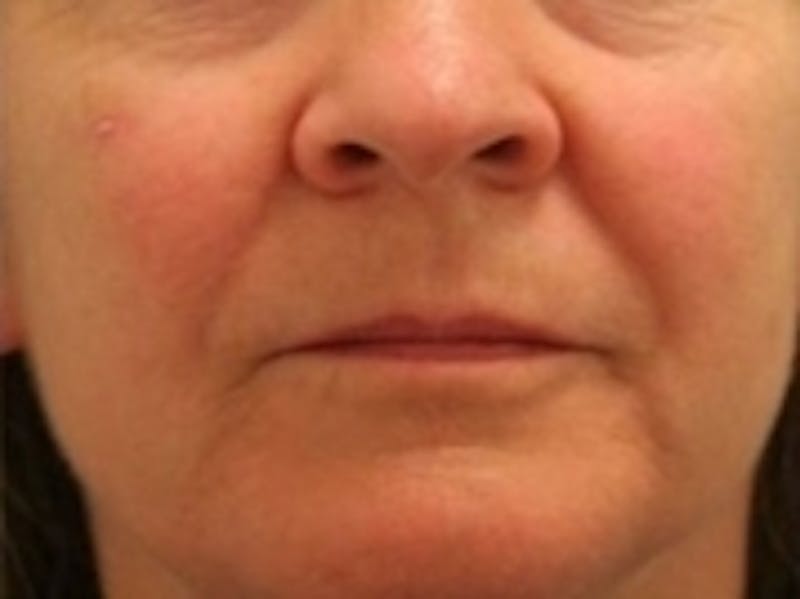 Cosmetic Dermatology Before & After Gallery - Patient 20493273 - Image 2