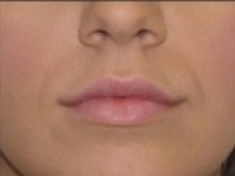 Dermal Fillers Before & After Gallery - Patient 20493274 - Image 2