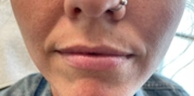 Lip Augmentation Before & After Gallery - Patient 20493278 - Image 1