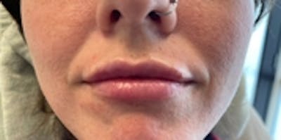 Lip Augmentation Before & After Gallery - Patient 20493278 - Image 2