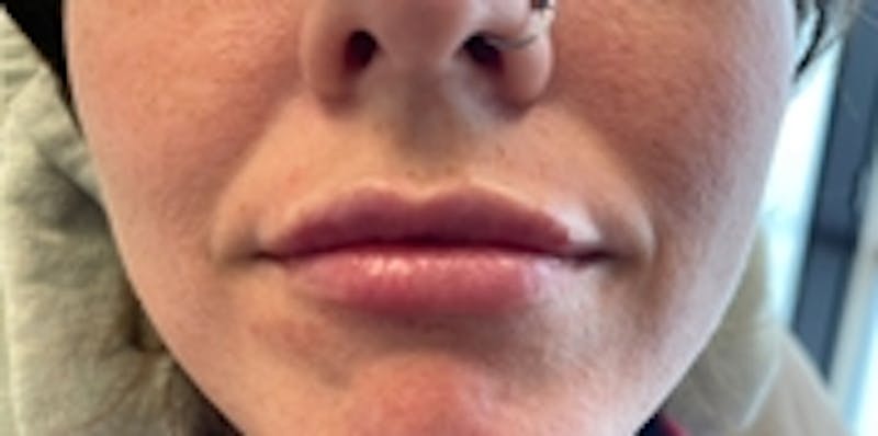 Lip Augmentation Before & After Gallery - Patient 20493278 - Image 2