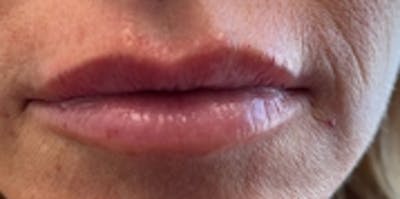 Lip Augmentation Before & After Gallery - Patient 20493280 - Image 2