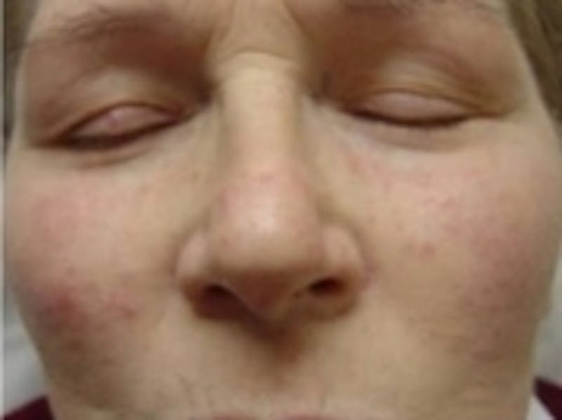 Cosmetic Dermatology Before & After Gallery - Patient 20493821 - Image 2
