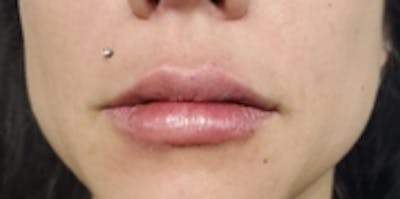 Lip Augmentation Before & After Gallery - Patient 20493823 - Image 2