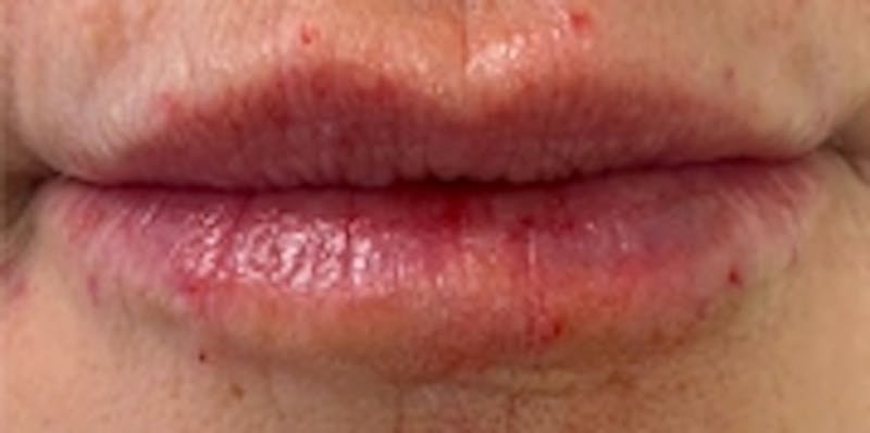 Lip Augmentation Before & After Gallery - Patient 20493824 - Image 2