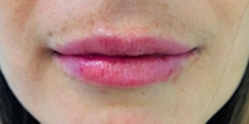 Lip Augmentation Before & After Gallery - Patient 20493829 - Image 1