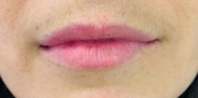 Lip Augmentation Before & After Gallery - Patient 20493829 - Image 2