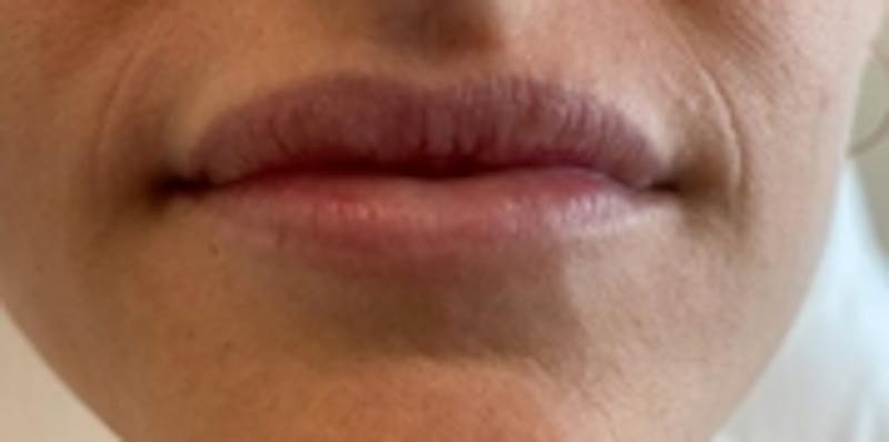 Lip Augmentation Before & After Gallery - Patient 20493830 - Image 1
