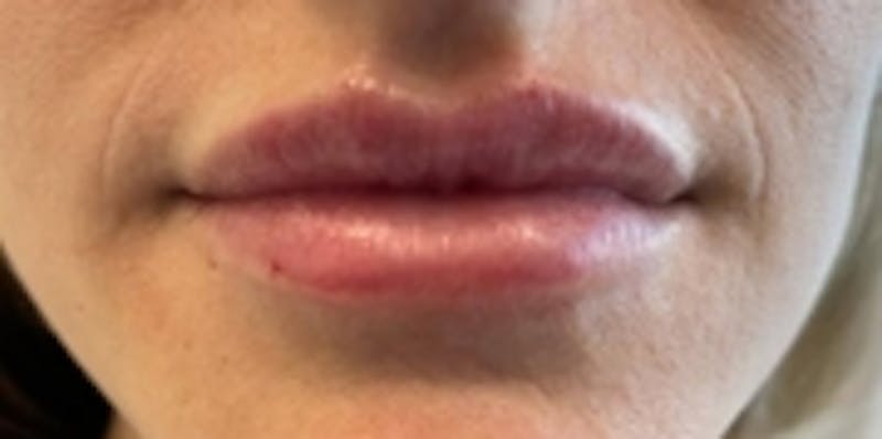 Lip Augmentation Before & After Gallery - Patient 20493830 - Image 2