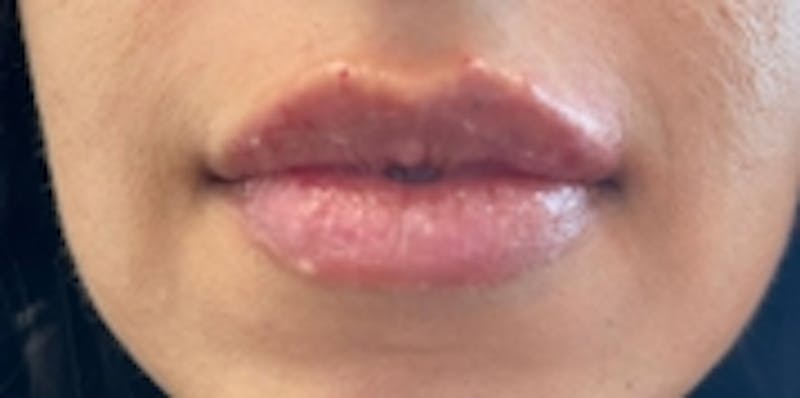 Lip Augmentation Before & After Gallery - Patient 20493831 - Image 2
