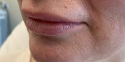 Lip Augmentation Before & After Gallery - Patient 20493832 - Image 2