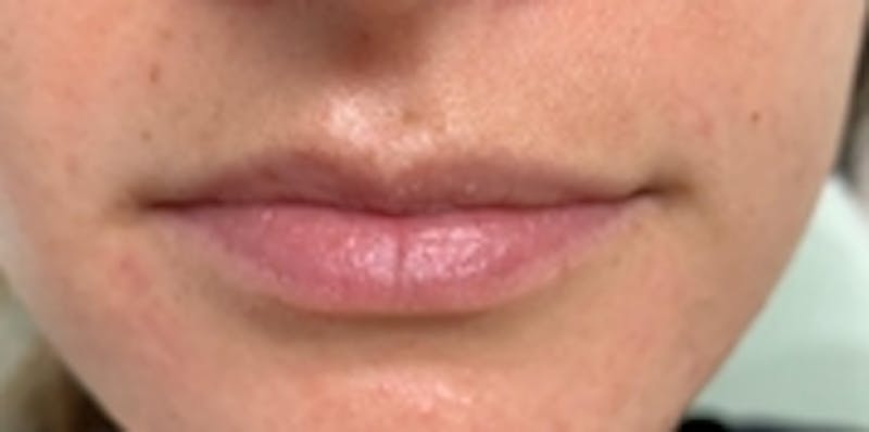 Lip Augmentation Before & After Gallery - Patient 20494373 - Image 1