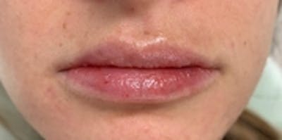Lip Augmentation Before & After Gallery - Patient 20494373 - Image 2