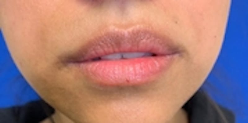 Lip Augmentation Before & After Gallery - Patient 20494375 - Image 1