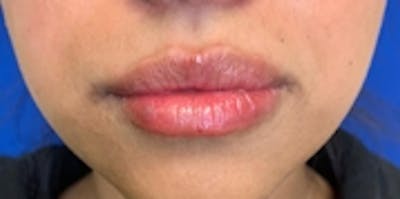 Lip Augmentation Before & After Gallery - Patient 20494375 - Image 2