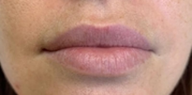 Lip Augmentation Before & After Gallery - Patient 20494377 - Image 1
