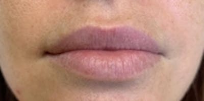 Lip Augmentation Before & After Gallery - Patient 20494377 - Image 1