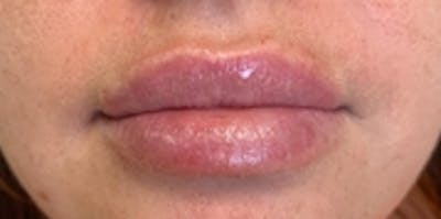 Lip Augmentation Before & After Gallery - Patient 20494377 - Image 2