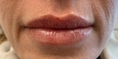 Lip Augmentation Before & After Gallery - Patient 20494379 - Image 2