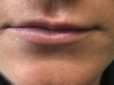 Lip Augmentation Before & After Gallery - Patient 20494380 - Image 1