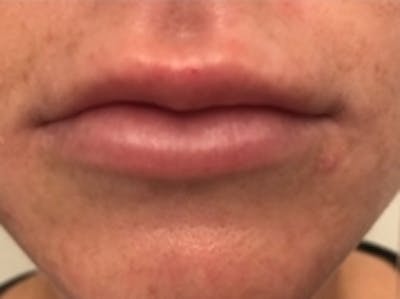 Lip Augmentation Before & After Gallery - Patient 20494380 - Image 2