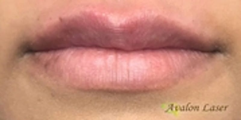 Lip Augmentation Before & After Gallery - Patient 20494384 - Image 2