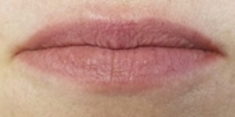 Lip Augmentation Before & After Gallery - Patient 20494385 - Image 1