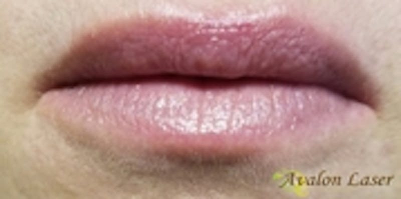 Lip Augmentation Before & After Gallery - Patient 20494385 - Image 2