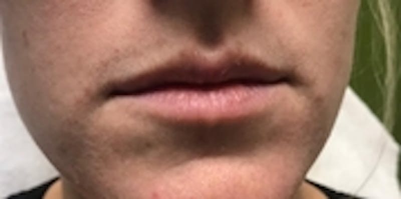 Lip Augmentation Before & After Gallery - Patient 20495372 - Image 1