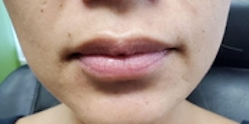 Lip Augmentation Before & After Gallery - Patient 20495373 - Image 1