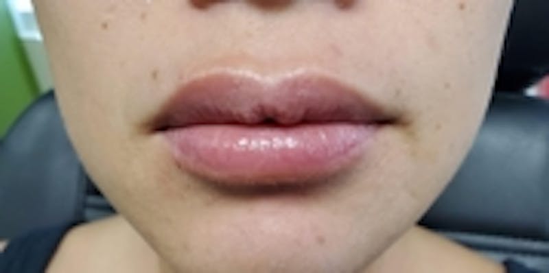 Lip Augmentation Before & After Gallery - Patient 20495373 - Image 2