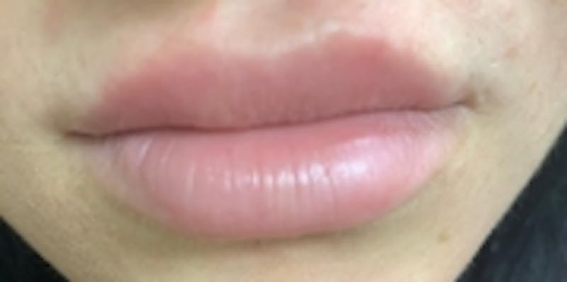Lip Augmentation Before & After Gallery - Patient 20495374 - Image 2