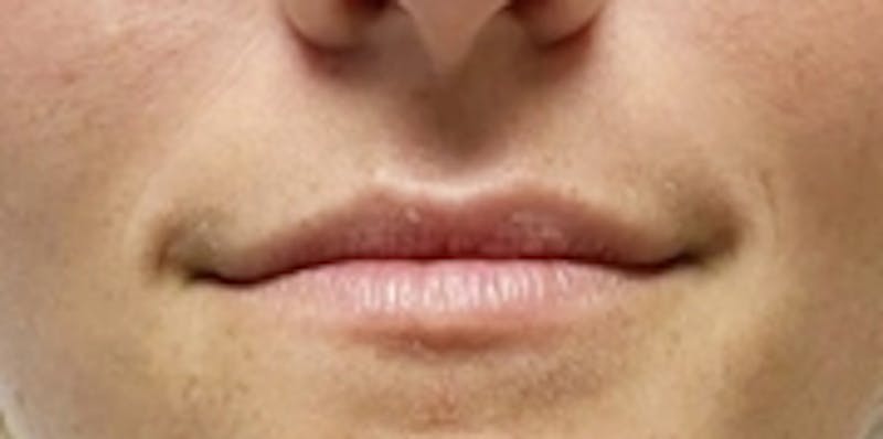 Lip Augmentation Before & After Gallery - Patient 20495375 - Image 1