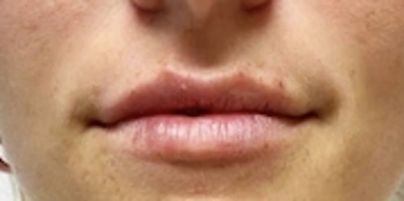 Lip Augmentation Before & After Gallery - Patient 20495375 - Image 2