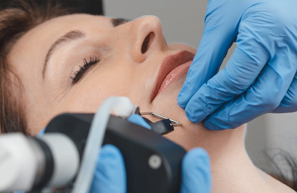 Woman Receiving Laser Treatment on Her Face