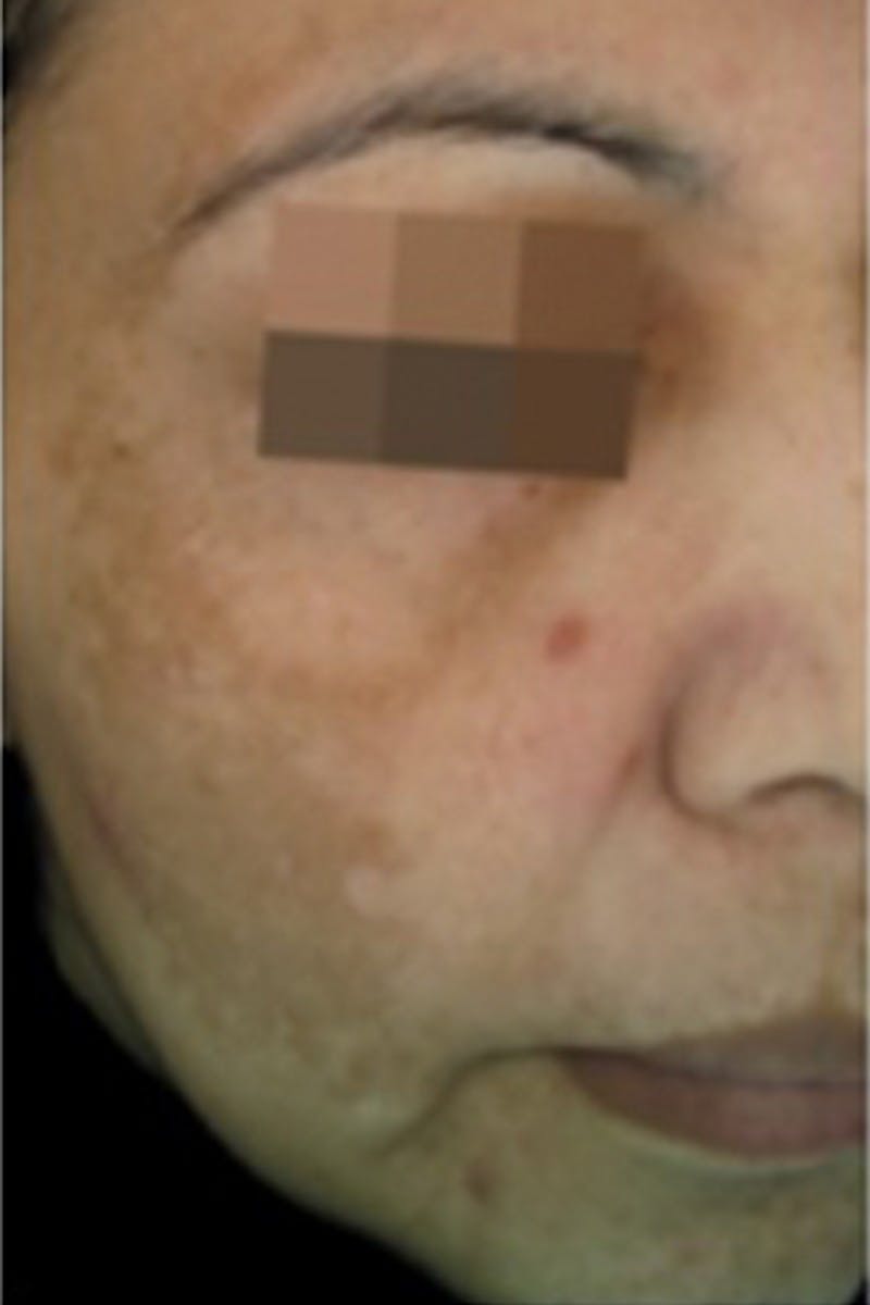 Cosmelan Peel Before & After Gallery - Patient 47633825 - Image 1