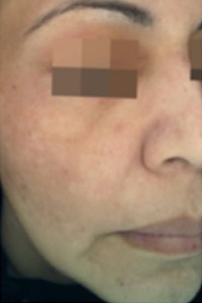 Cosmelan Peel Before & After Gallery - Patient 47633825 - Image 2