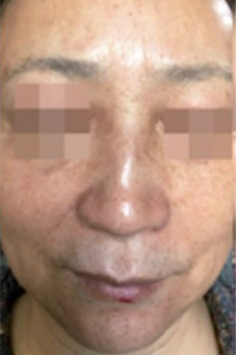 Cosmelan Peel Before & After Gallery - Patient 47633825 - Image 3