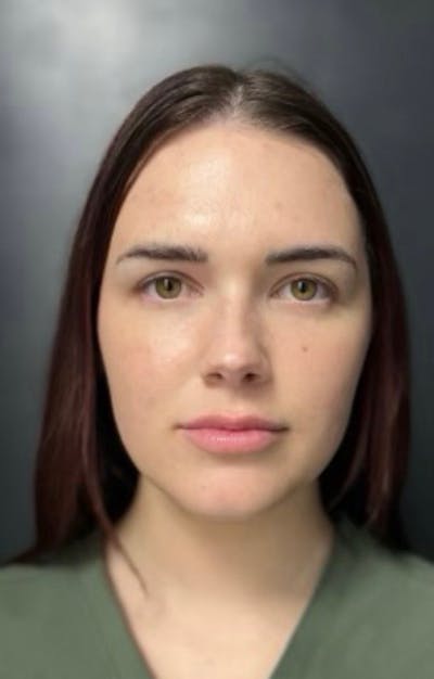 Injectables Before & After Gallery - Patient 384428 - Image 1