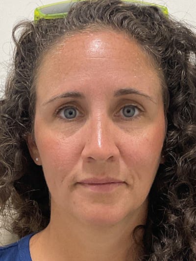 Injectables Before & After Gallery - Patient 205747 - Image 1