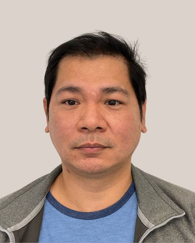 CO2 Laser Before & After Gallery - Patient 809840 - Image 1