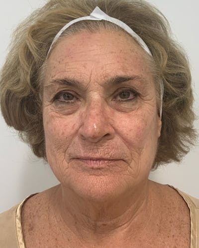 BBL Forever Young Before & After Gallery - Patient 226729 - Image 1