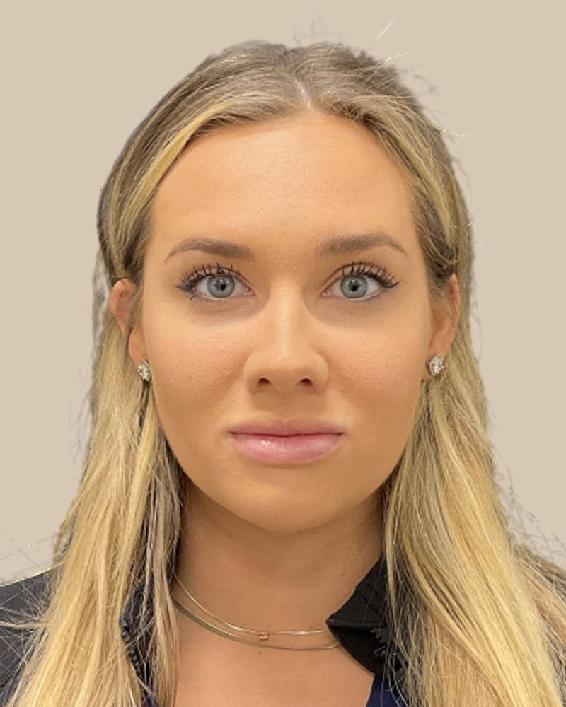 Injectables Before & After Gallery - Patient 350966 - Image 2