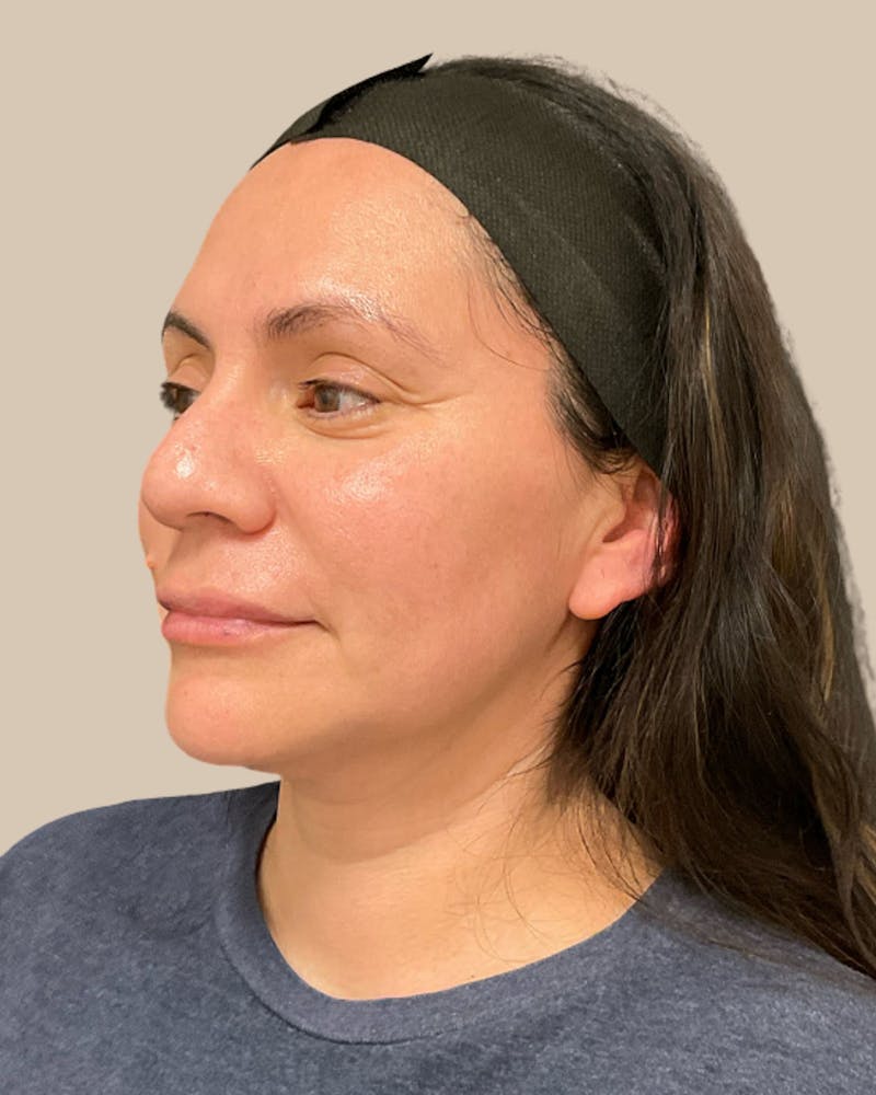 Microneedling Before & After Gallery - Patient 314533 - Image 4