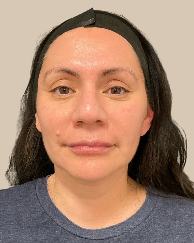 Microneedling Before & After Gallery - Patient 314533 - Image 2