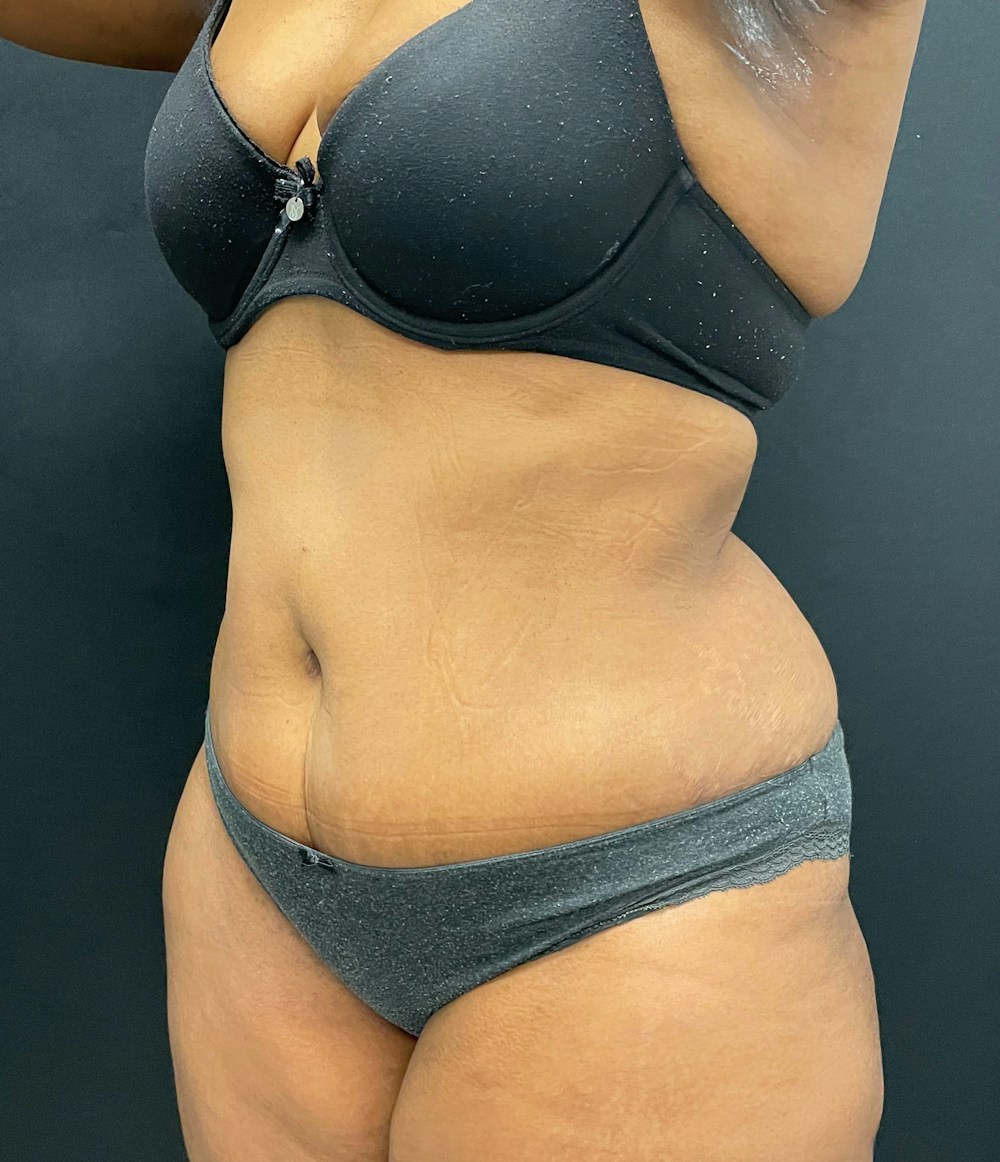 Tummy Tuck Before & After Gallery - Patient 58242706 - Image 4