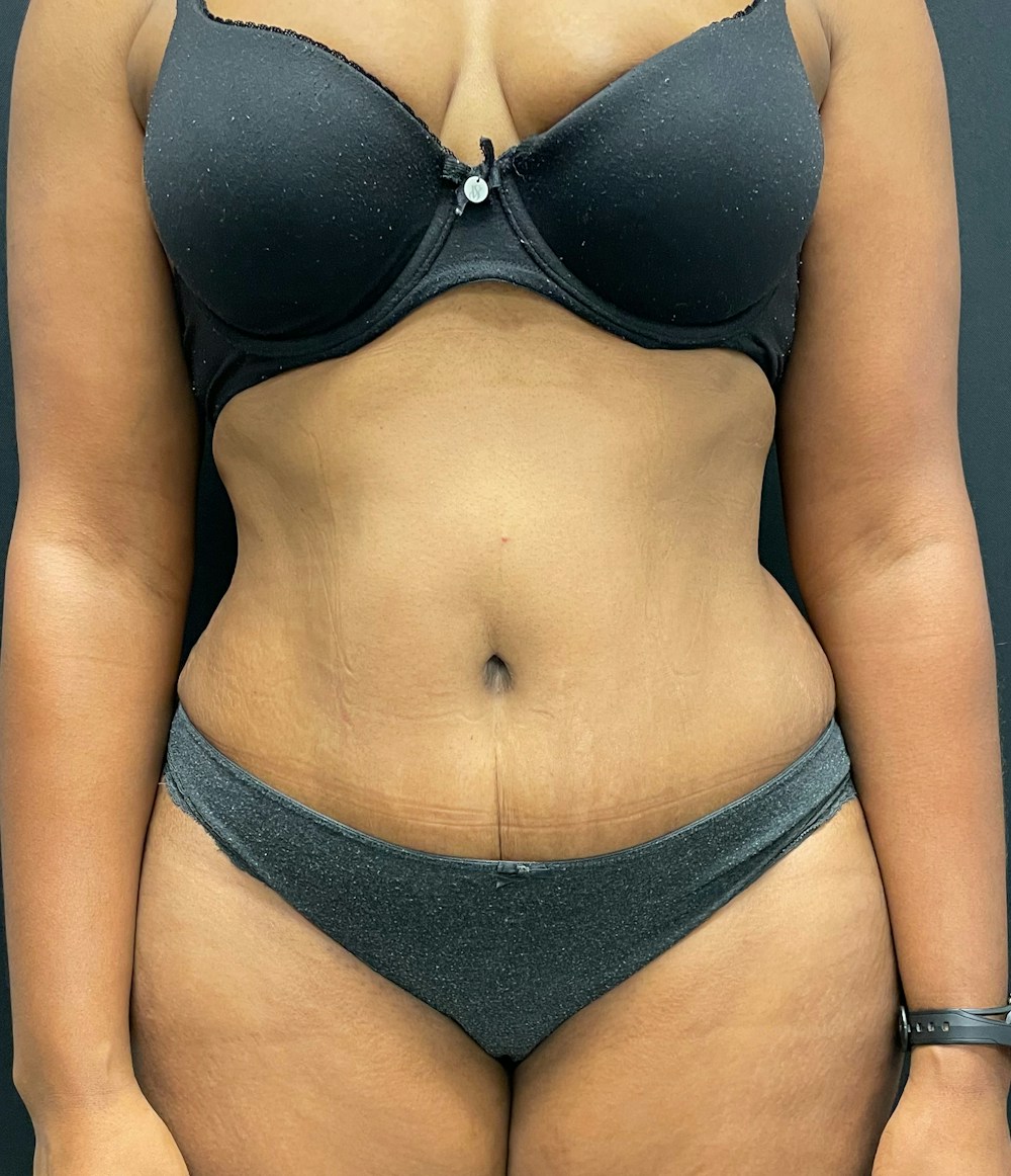 Tummy Tuck Before & After Gallery - Patient 58242706 - Image 2