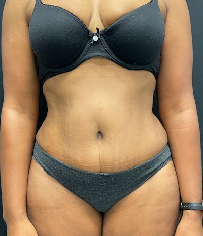 Tummy Tuck Before & After Gallery - Patient 58242706 - Image 2