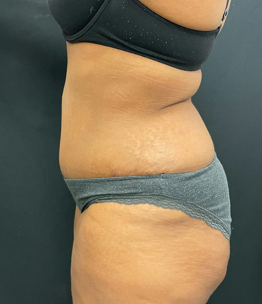 Liposuction Before & After Gallery - Patient 72243588 - Image 6
