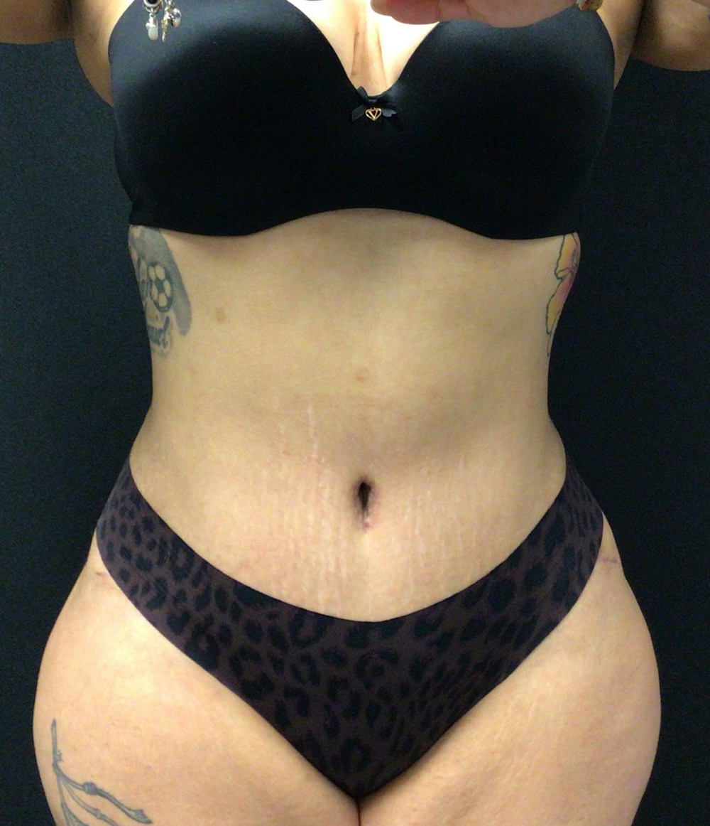 Tummy Tuck Before & After Gallery - Patient 58242838 - Image 2